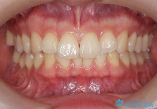 ワイヤー矯正がしたいの症例 治療前