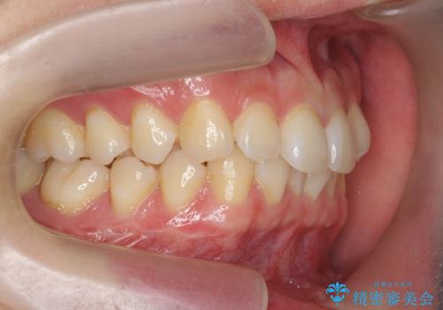 ワイヤー矯正がしたいの治療前