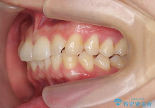 ワイヤー矯正がしたいの治療前