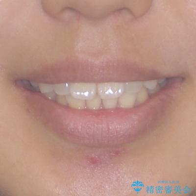 前に出ている前歯を引っ込めたい インビザライン矯正の治療前(顔貌)