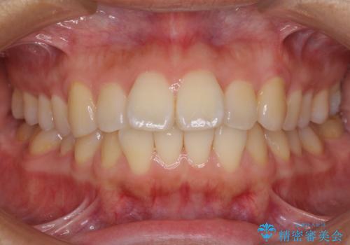 前に出ている前歯を引っ込めたい インビザライン矯正の症例 治療前