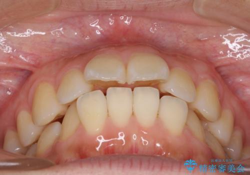 前に出ている前歯を引っ込めたい インビザライン矯正の治療前