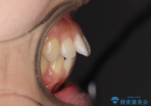 前に出ている前歯を引っ込めたい インビザライン矯正の治療前