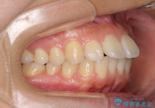 前に出ている前歯を引っ込めたい インビザライン矯正の治療前