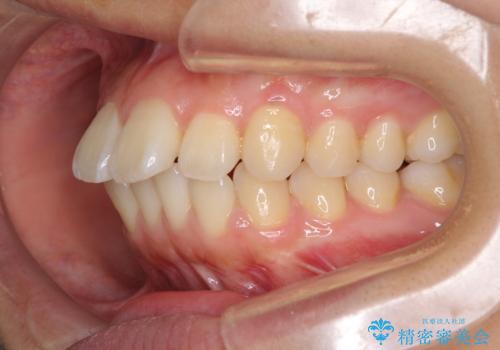 前に出ている前歯を引っ込めたい インビザライン矯正の治療前