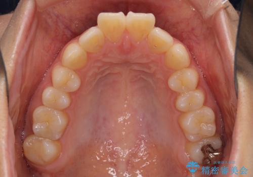 前に出ている前歯を引っ込めたい インビザライン矯正の治療前