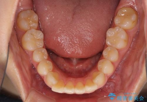 前に出ている前歯を引っ込めたい インビザライン矯正の治療前