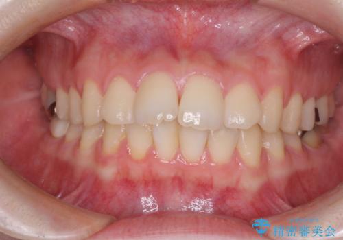 デコボコ歯列をきれいに インビザラインによる矯正治療の症例 治療前