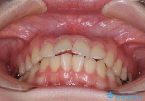 デコボコ歯列をきれいに インビザラインによる矯正治療の治療前