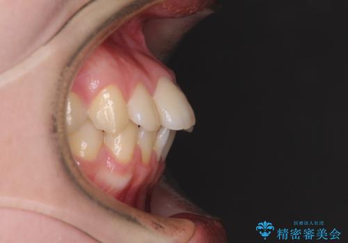 デコボコ歯列をきれいに インビザラインによる矯正治療の治療前