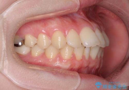デコボコ歯列をきれいに　インビザラインによる矯正治療の治療前