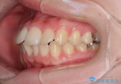 デコボコ歯列をきれいに インビザラインによる矯正治療の治療前