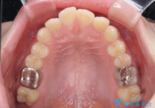 デコボコ歯列をきれいに インビザラインによる矯正治療の治療前