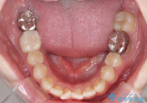 デコボコ歯列をきれいに インビザラインによる矯正治療の治療前