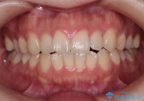 【インビザライン】前歯の凸凹を治したいの治療前