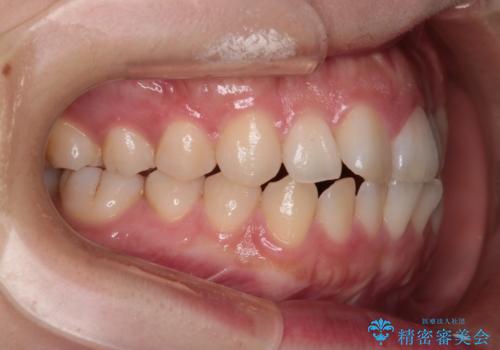 【インビザライン】前歯の凸凹を治したいの治療前