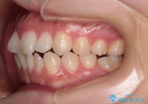 【インビザライン】前歯の凸凹を治したいの治療前