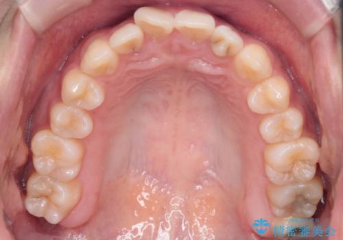 【インビザライン】前歯の凸凹を治したいの治療前