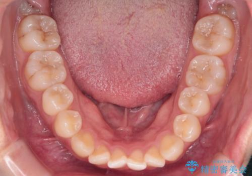 【インビザライン】前歯の凸凹を治したいの治療前