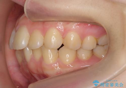 奥歯のかみ合わせも妥協しない　インビザライン治療の治療中