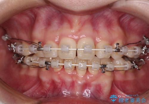 抜歯矯正へ切り替え　表側のワイヤー矯正の治療中