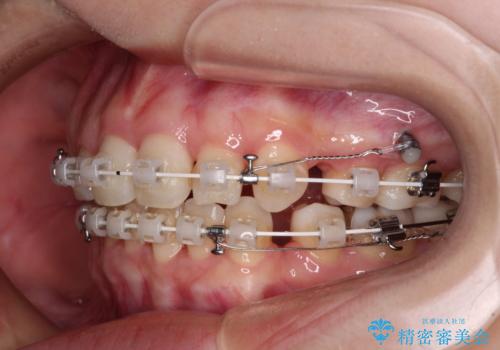 抜歯矯正へ切り替え　表側のワイヤー矯正の治療中