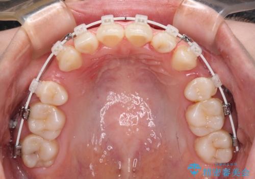 抜歯矯正へ切り替え　表側のワイヤー矯正の治療中
