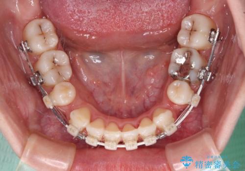 抜歯矯正へ切り替え　表側のワイヤー矯正の治療中