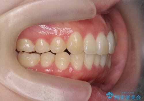 [ インビザライン矯正 ]  マウスピースで治す前歯のがたつきの治療中