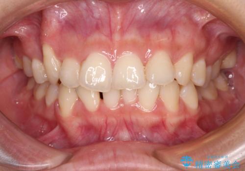 八重歯の抜歯矯正　補助装置とワイヤーを併用したインビザライン矯正治療の治療中