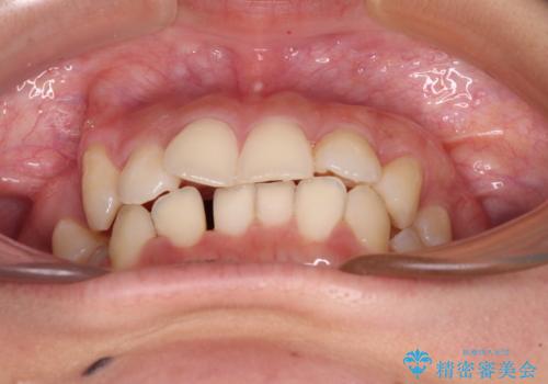 八重歯の抜歯矯正 補助装置とワイヤーを併用したインビザライン矯正治療の治療中