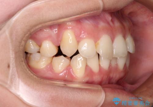 八重歯の抜歯矯正 補助装置とワイヤーを併用したインビザライン矯正治療の治療中