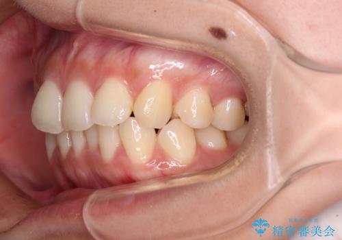 八重歯の抜歯矯正　補助装置とワイヤーを併用したインビザライン矯正治療の治療中