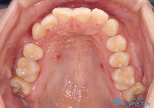 八重歯の抜歯矯正 補助装置とワイヤーを併用したインビザライン矯正治療の治療中