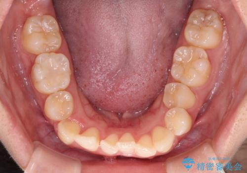 八重歯の抜歯矯正 補助装置とワイヤーを併用したインビザライン矯正治療の治療中
