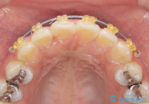 ワイヤーの小矯正を行い、治療期間を短縮するマウスピース治療の治療後