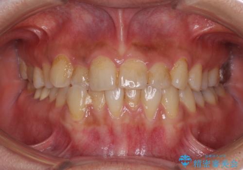 前歯のデコボコとクロスバイト　インビザラインによる矯正治療の症例 治療前