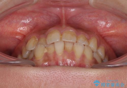 前歯のデコボコとクロスバイト インビザラインによる矯正治療の治療前