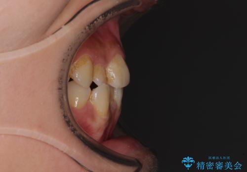前歯のデコボコとクロスバイト インビザラインによる矯正治療の治療前