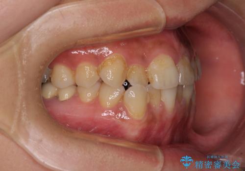 前歯のデコボコとクロスバイト　インビザラインによる矯正治療の治療前