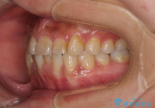 前歯のデコボコとクロスバイト インビザラインによる矯正治療の治療前