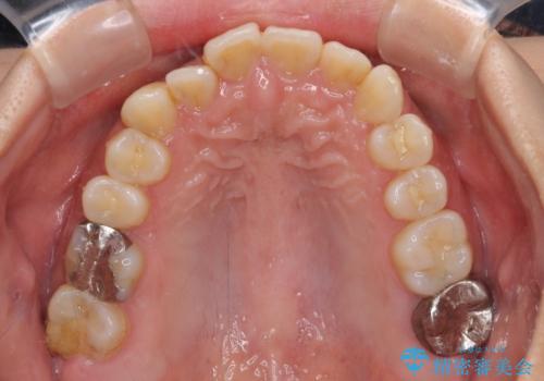 前歯のデコボコとクロスバイト インビザラインによる矯正治療の治療前