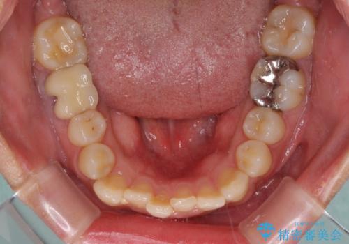 前歯のデコボコとクロスバイト インビザラインによる矯正治療の治療前