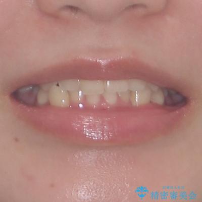 前歯のクロスバイト　ギラギラのワイヤー装置で矯正治療の治療前（顔貌）