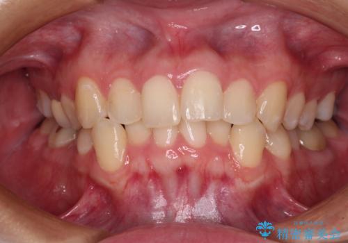 前歯のクロスバイト　ギラギラのワイヤー装置で矯正治療の症例 治療前