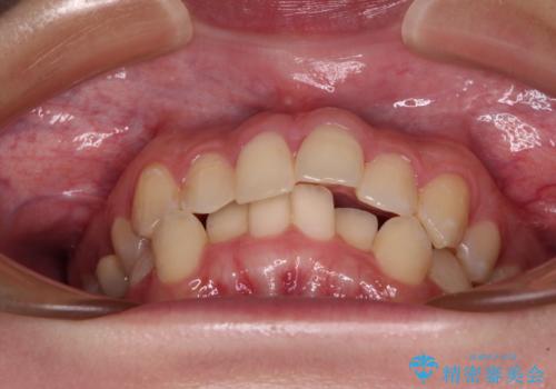 前歯のクロスバイト ギラギラのワイヤー装置で矯正治療の治療前