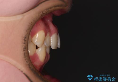 前歯のクロスバイト ギラギラのワイヤー装置で矯正治療の治療前