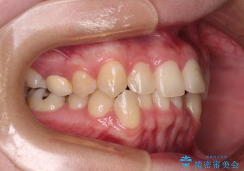前歯のクロスバイト　ギラギラのワイヤー装置で矯正治療の治療前