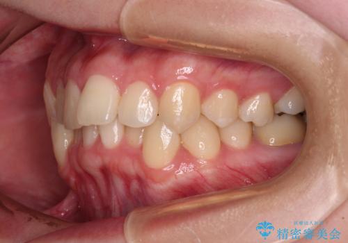 前歯のクロスバイト ギラギラのワイヤー装置で矯正治療の治療前