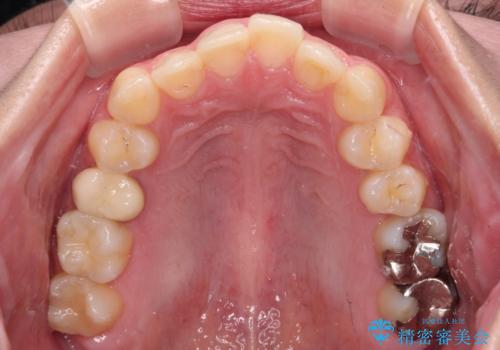 前歯のクロスバイト ギラギラのワイヤー装置で矯正治療の治療前